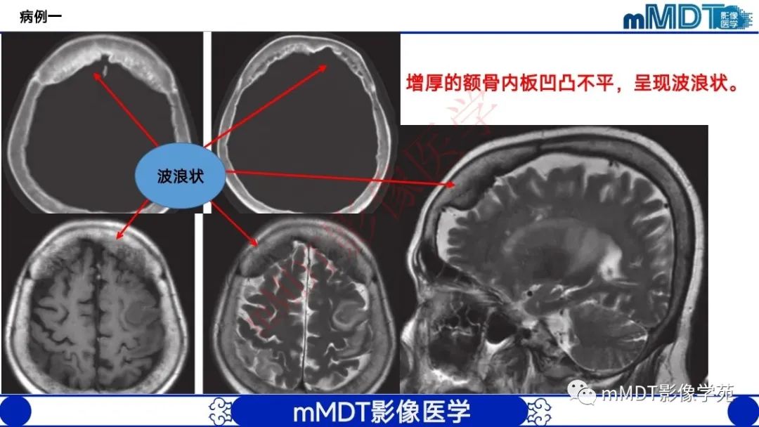影像PPT - 【PPT】颅骨“弥漫性”增厚影像剖析-27