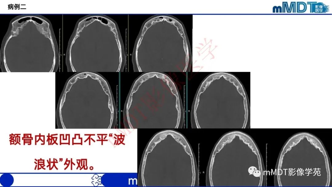 影像PPT - 【PPT】颅骨“弥漫性”增厚影像剖析-28