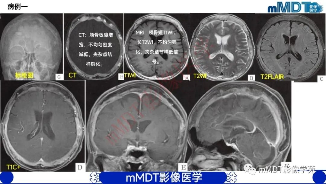 影像PPT - 【PPT】颅骨“弥漫性”增厚影像剖析-31