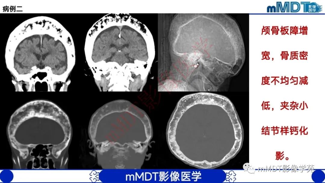 影像PPT - 【PPT】颅骨“弥漫性”增厚影像剖析-32