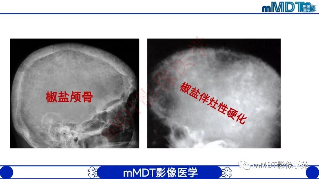 影像PPT - 【PPT】颅骨“弥漫性”增厚影像剖析-37