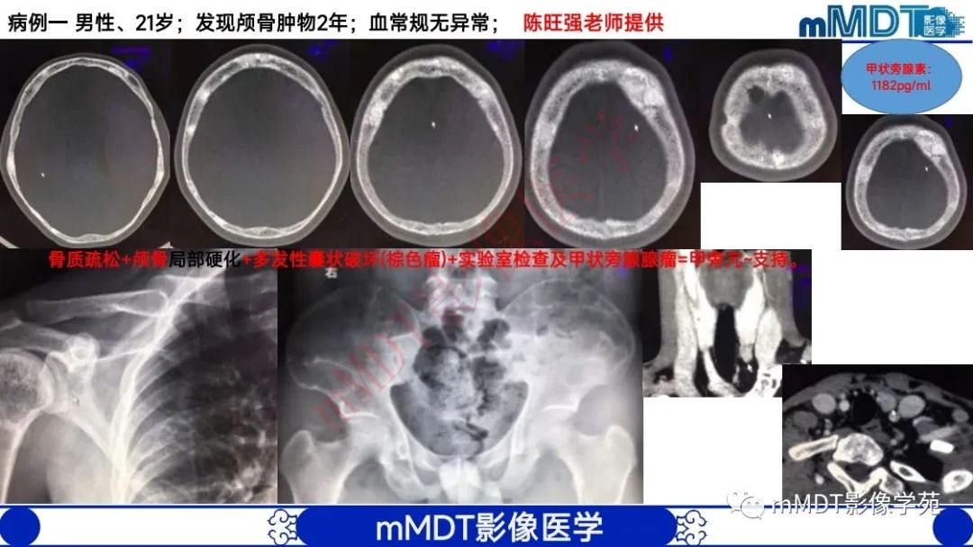 影像PPT - 【PPT】颅骨“弥漫性”增厚影像剖析-36