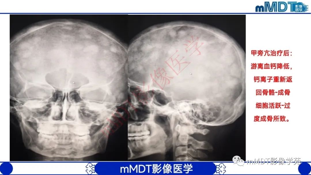 影像PPT - 【PPT】颅骨“弥漫性”增厚影像剖析-38
