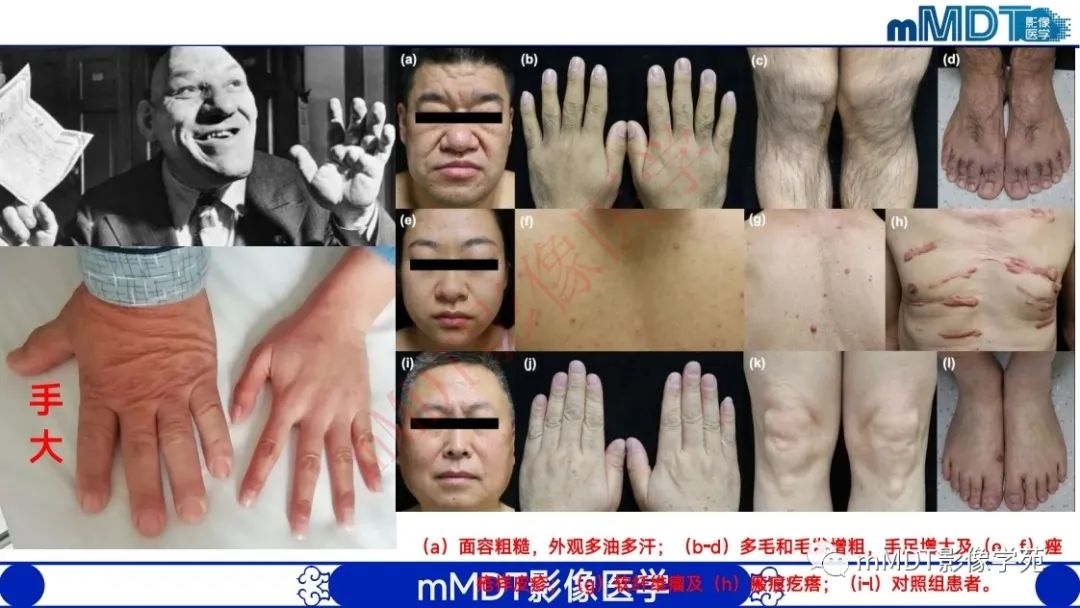 影像PPT - 【PPT】颅骨“弥漫性”增厚影像剖析-40