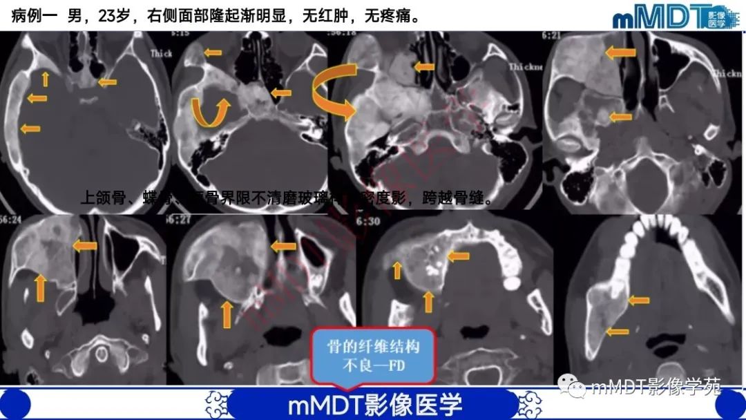 影像PPT - 【PPT】颅骨“弥漫性”增厚影像剖析-45