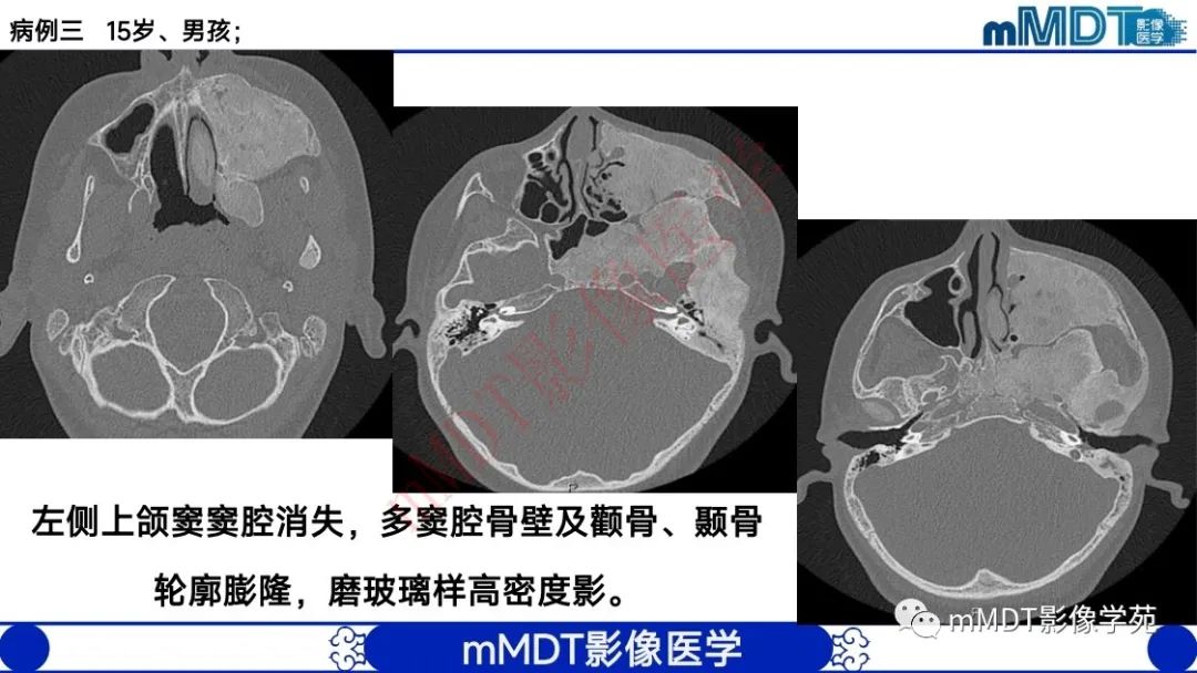 影像PPT - 【PPT】颅骨“弥漫性”增厚影像剖析-47