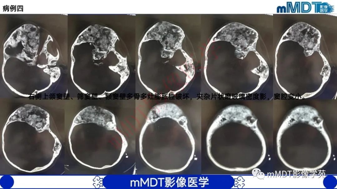 影像PPT - 【PPT】颅骨“弥漫性”增厚影像剖析-48