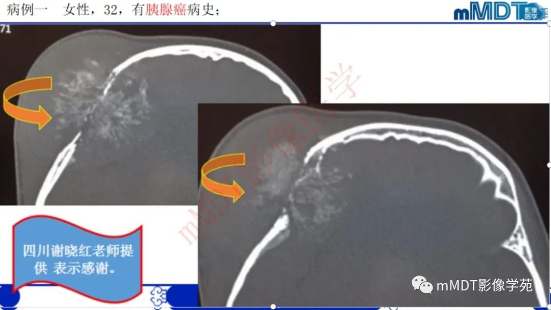 影像PPT - 【PPT】颅骨“弥漫性”增厚影像剖析-53