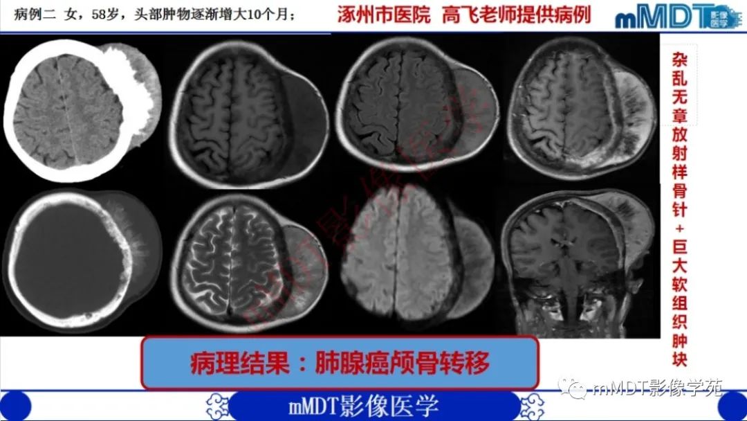 影像PPT - 【PPT】颅骨“弥漫性”增厚影像剖析-54