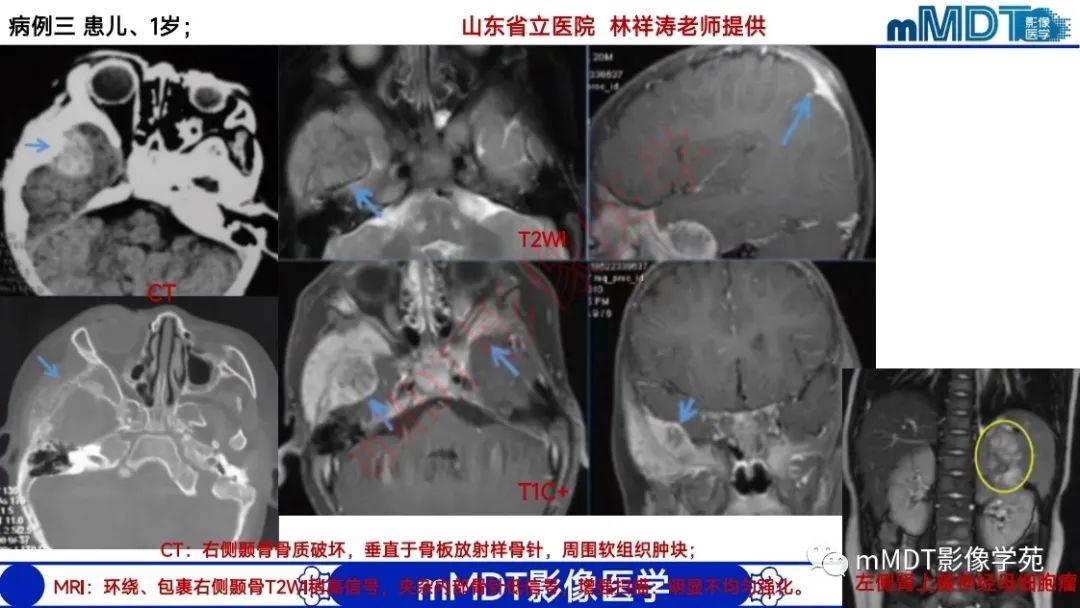 影像PPT - 【PPT】颅骨“弥漫性”增厚影像剖析-55