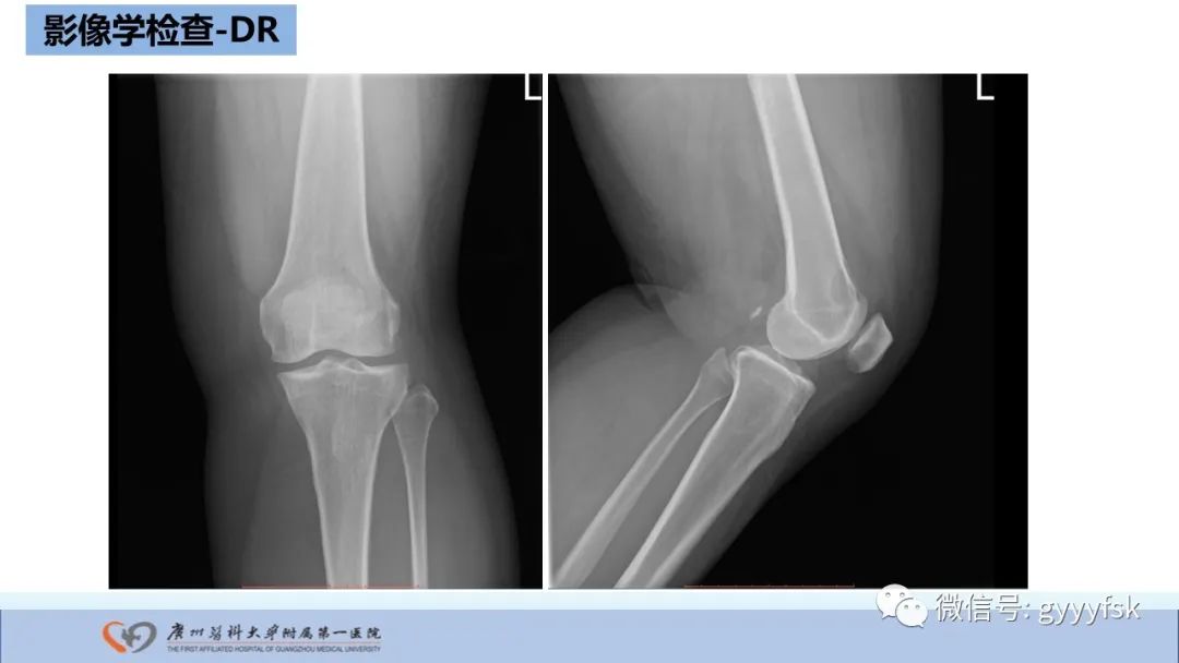 影像PPT - 【病例】股骨骨肉瘤1例X线CT及MR影像-5