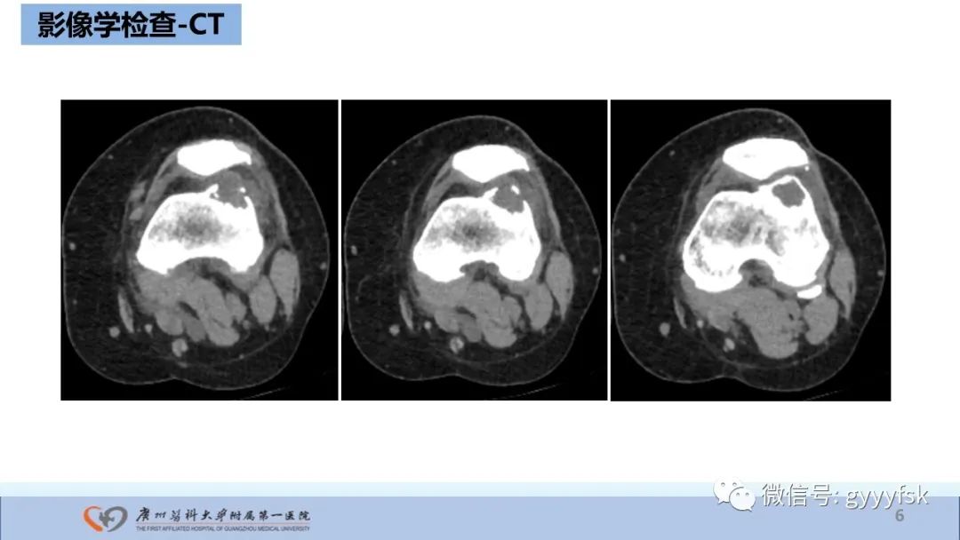 影像PPT - 【病例】股骨骨肉瘤1例X线CT及MR影像-6