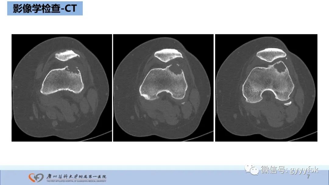 影像PPT - 【病例】股骨骨肉瘤1例X线CT及MR影像-7