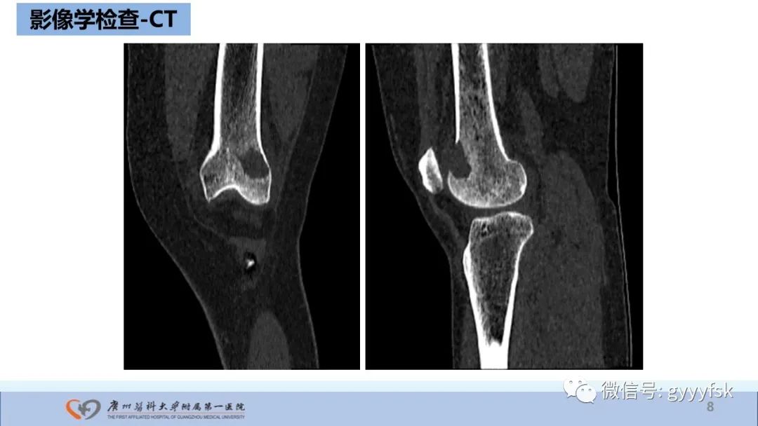 影像PPT - 【病例】股骨骨肉瘤1例X线CT及MR影像-8