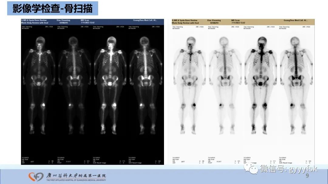 影像PPT - 【病例】股骨骨肉瘤1例X线CT及MR影像-9