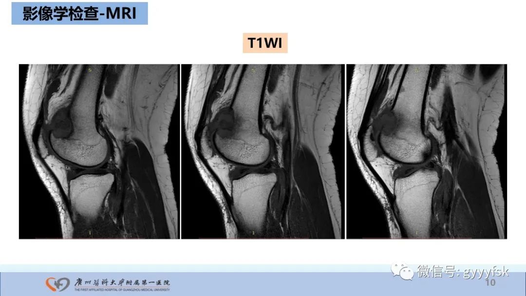 影像PPT - 【病例】股骨骨肉瘤1例X线CT及MR影像-10