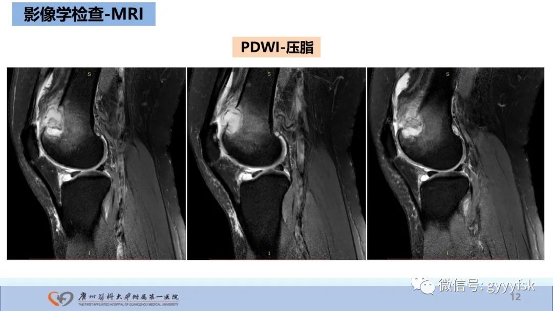 影像PPT - 【病例】股骨骨肉瘤1例X线CT及MR影像-12