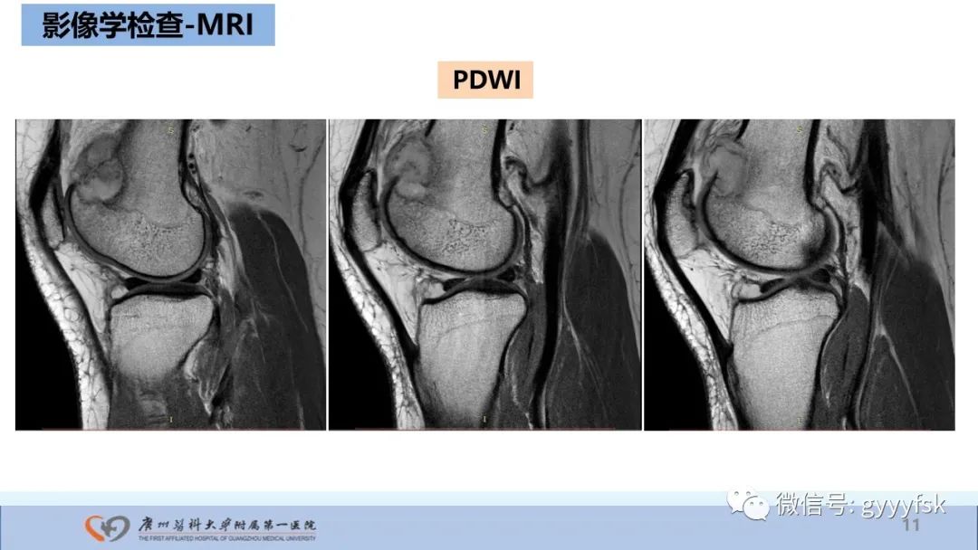 影像PPT - 【病例】股骨骨肉瘤1例X线CT及MR影像-11