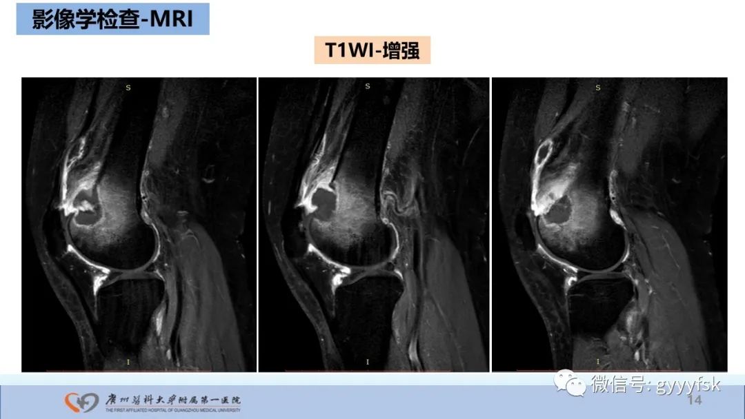 影像PPT - 【病例】股骨骨肉瘤1例X线CT及MR影像-14