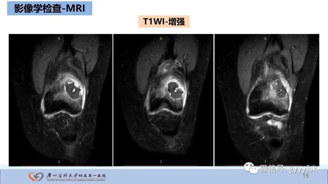 影像PPT - 【病例】股骨骨肉瘤1例X线CT及MR影像-15