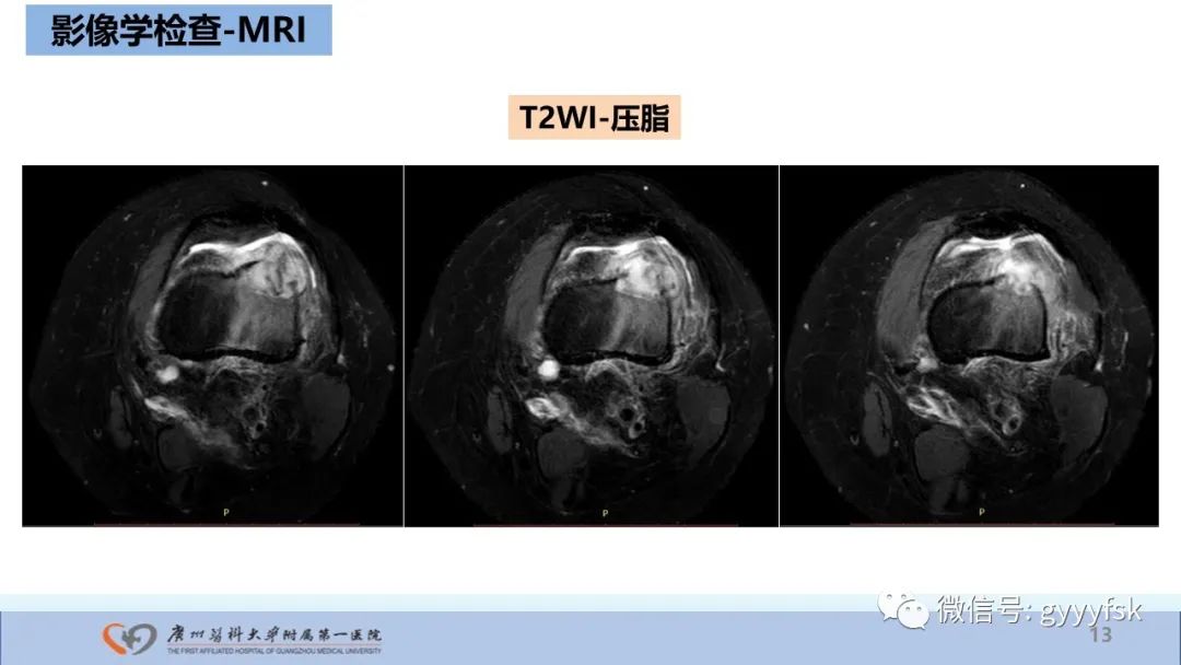 影像PPT - 【病例】股骨骨肉瘤1例X线CT及MR影像-13