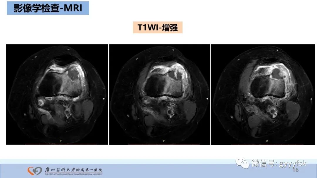 影像PPT - 【病例】股骨骨肉瘤1例X线CT及MR影像-16