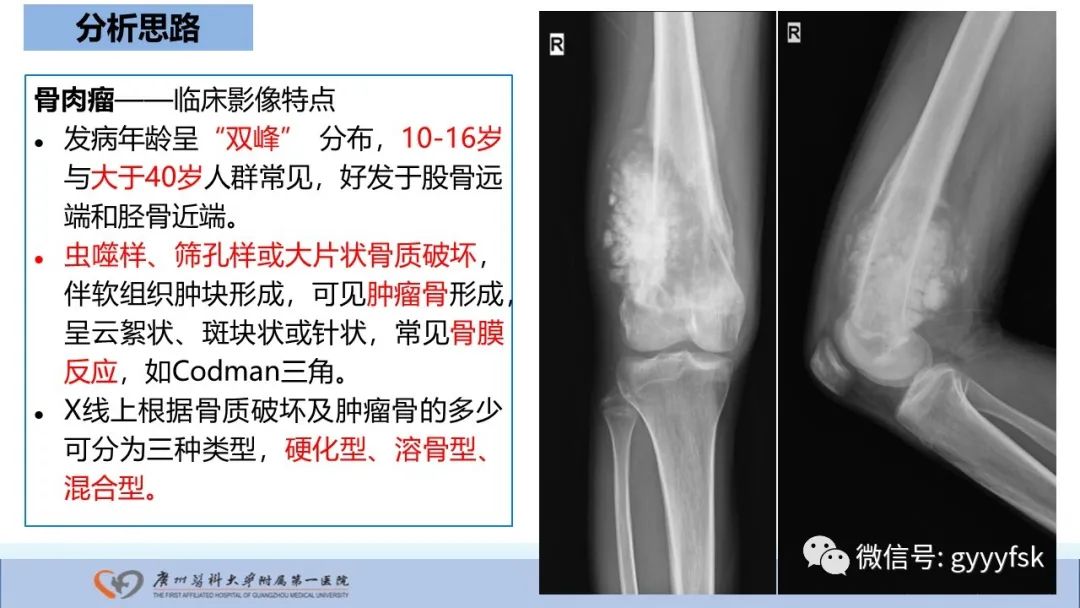 影像PPT - 【病例】股骨骨肉瘤1例X线CT及MR影像-21