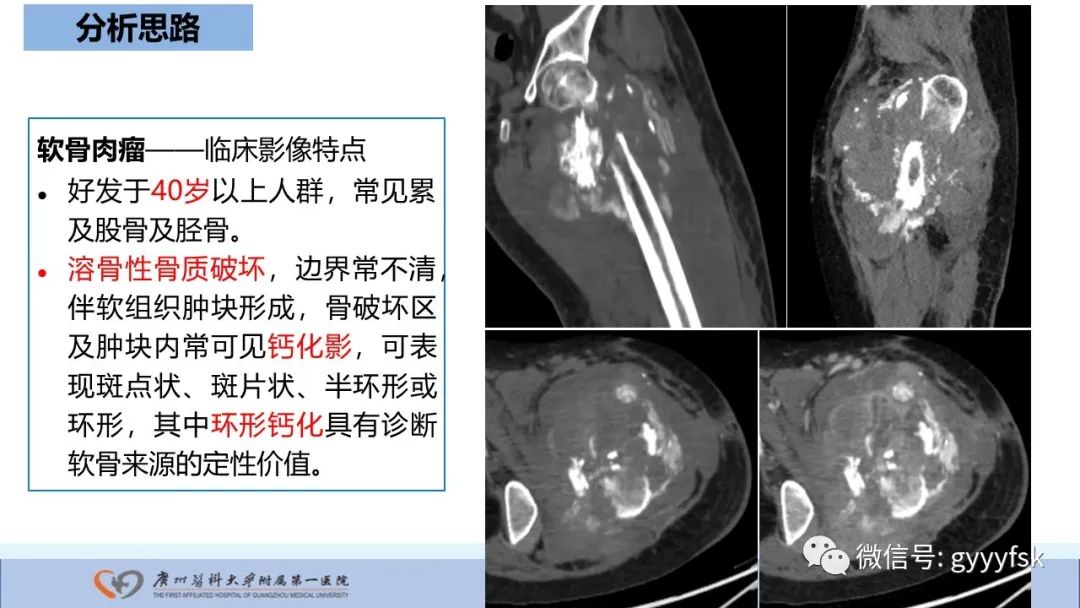影像PPT - 【病例】股骨骨肉瘤1例X线CT及MR影像-22