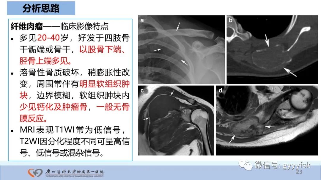 影像PPT - 【病例】股骨骨肉瘤1例X线CT及MR影像-23