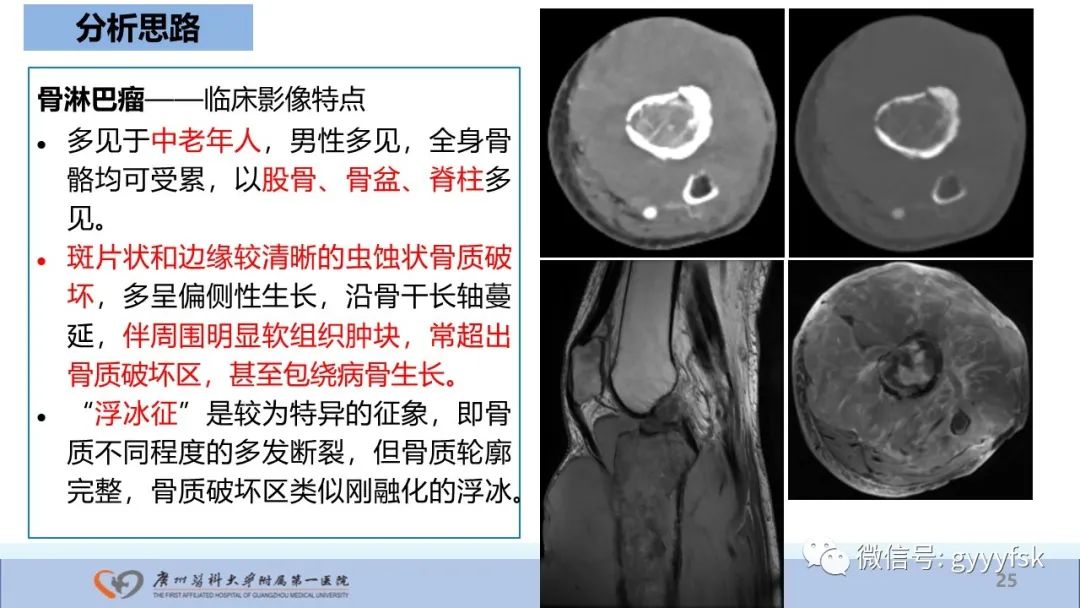 影像PPT - 【病例】股骨骨肉瘤1例X线CT及MR影像-25