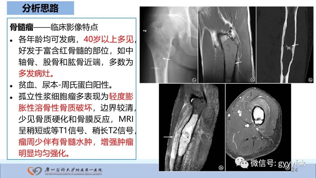影像PPT - 【病例】股骨骨肉瘤1例X线CT及MR影像-24