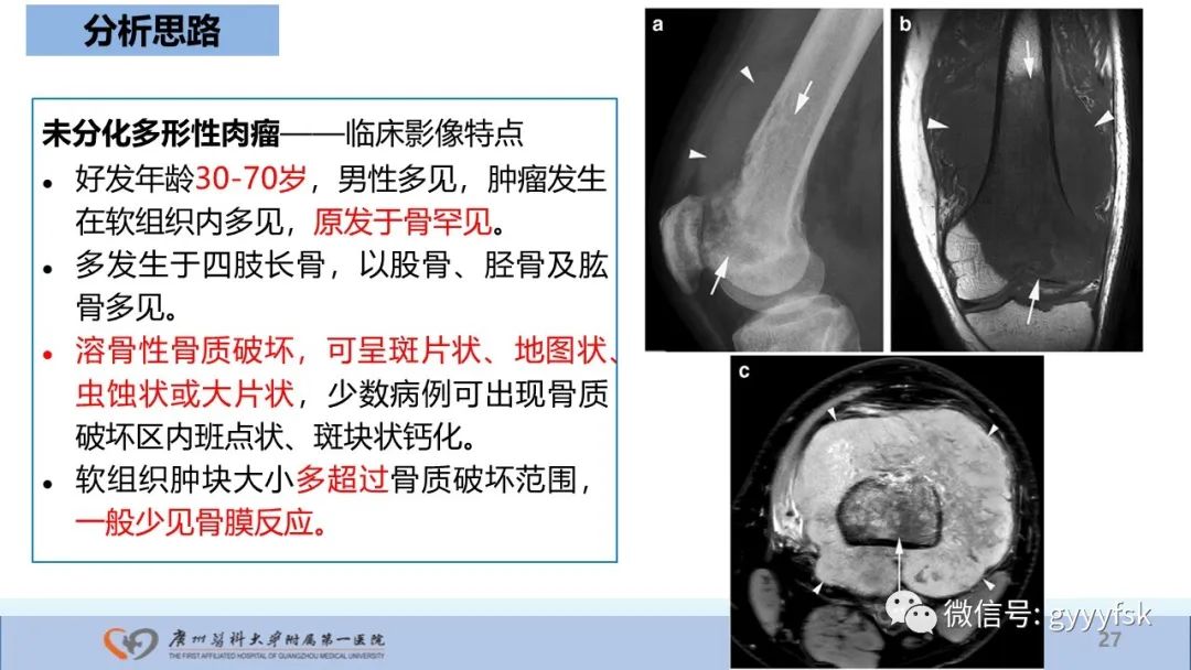 影像PPT - 【病例】股骨骨肉瘤1例X线CT及MR影像-27
