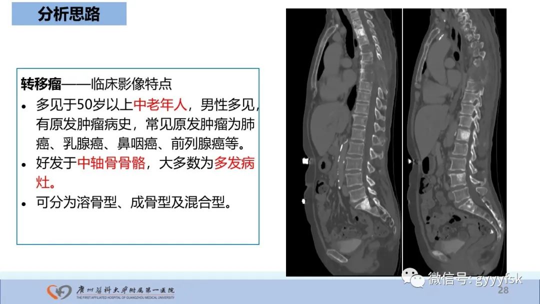 影像PPT - 【病例】股骨骨肉瘤1例X线CT及MR影像-28