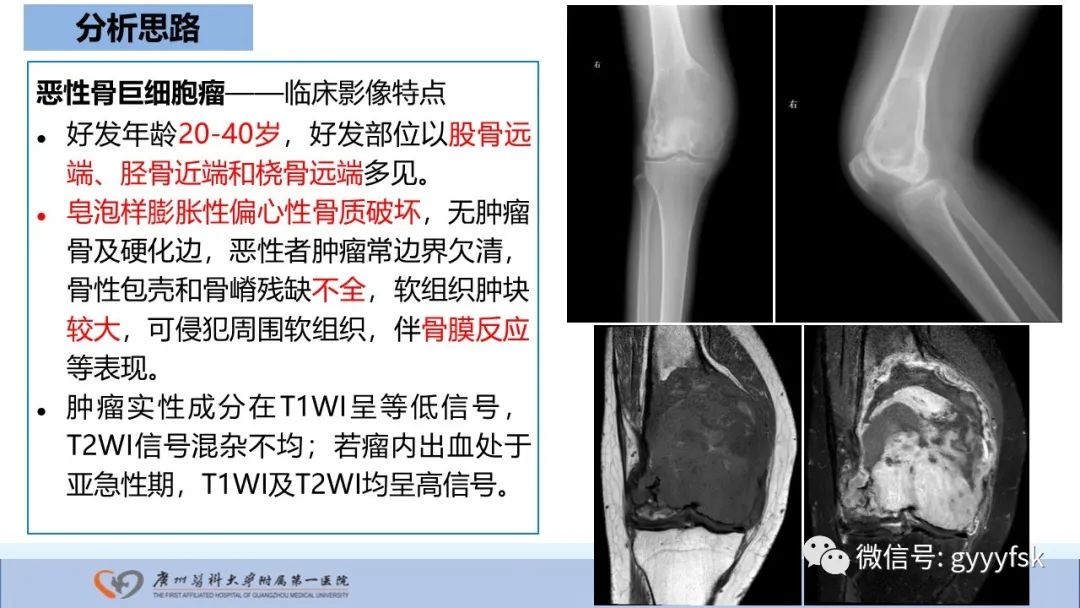 影像PPT - 【病例】股骨骨肉瘤1例X线CT及MR影像-26