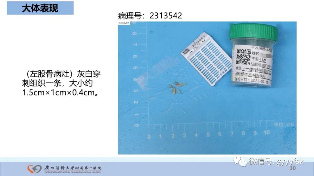 影像PPT - 【病例】股骨骨肉瘤1例X线CT及MR影像-30