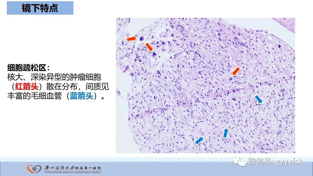 影像PPT - 【病例】股骨骨肉瘤1例X线CT及MR影像-33