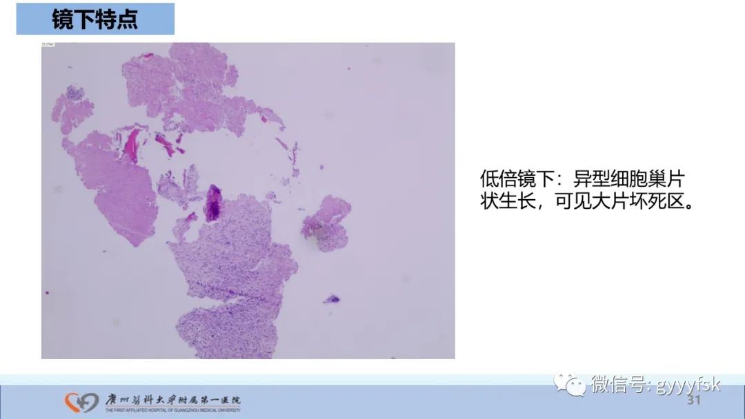 影像PPT - 【病例】股骨骨肉瘤1例X线CT及MR影像-31