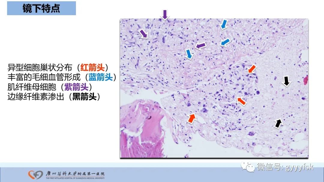 影像PPT - 【病例】股骨骨肉瘤1例X线CT及MR影像-34