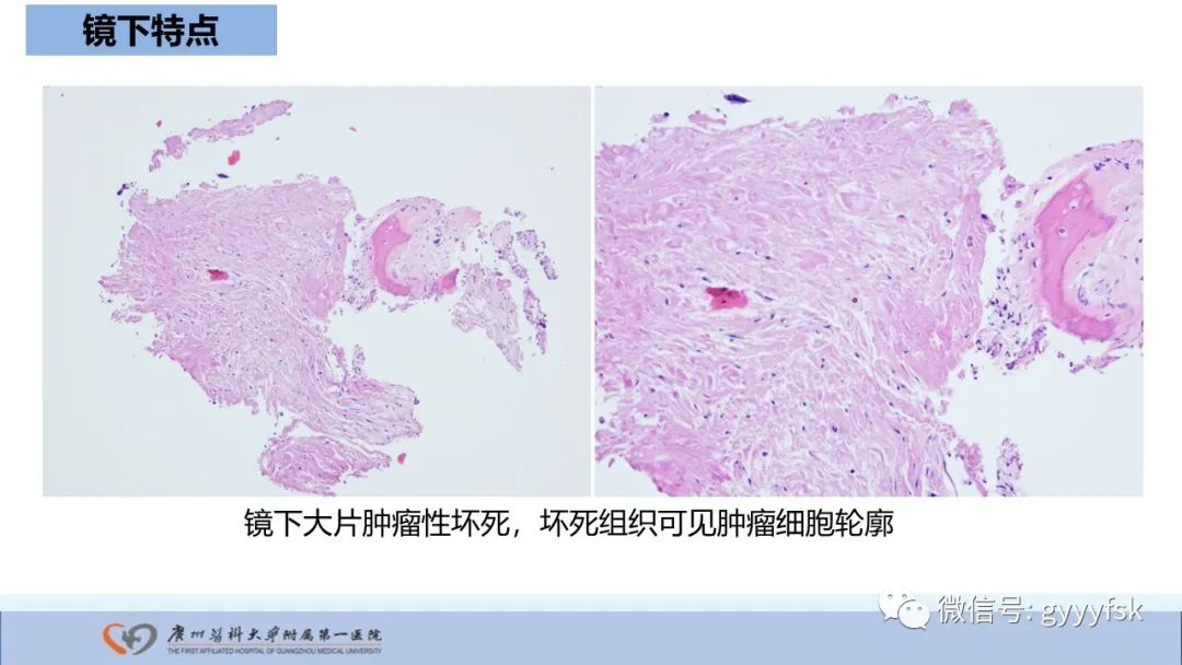影像PPT - 【病例】股骨骨肉瘤1例X线CT及MR影像-32