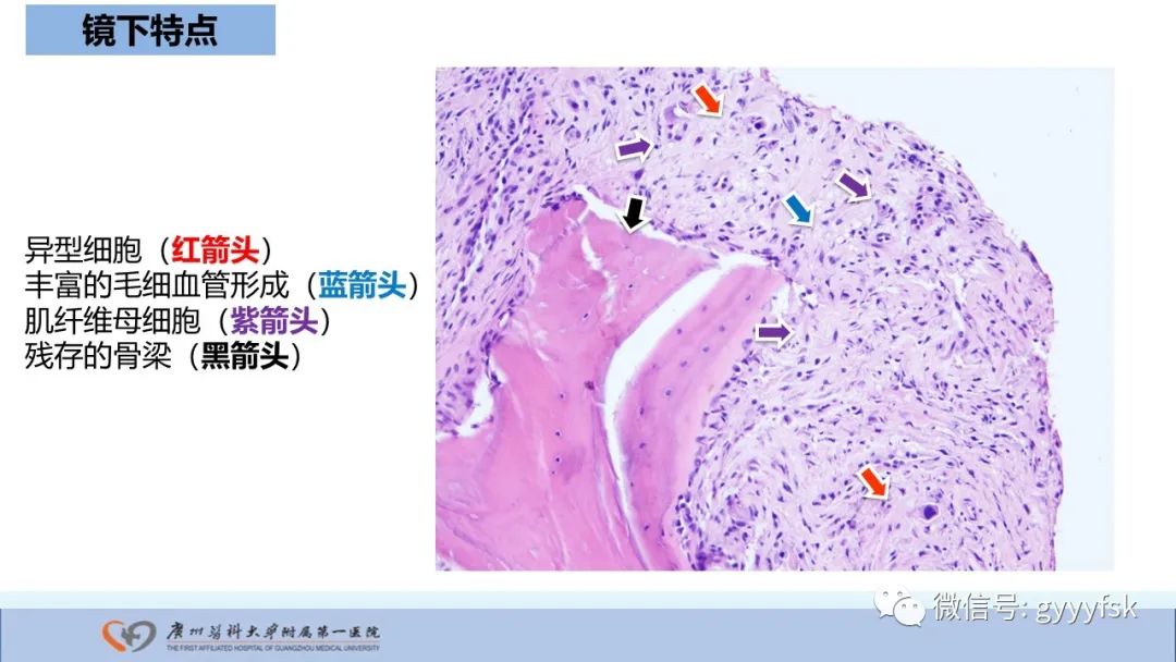 影像PPT - 【病例】股骨骨肉瘤1例X线CT及MR影像-35
