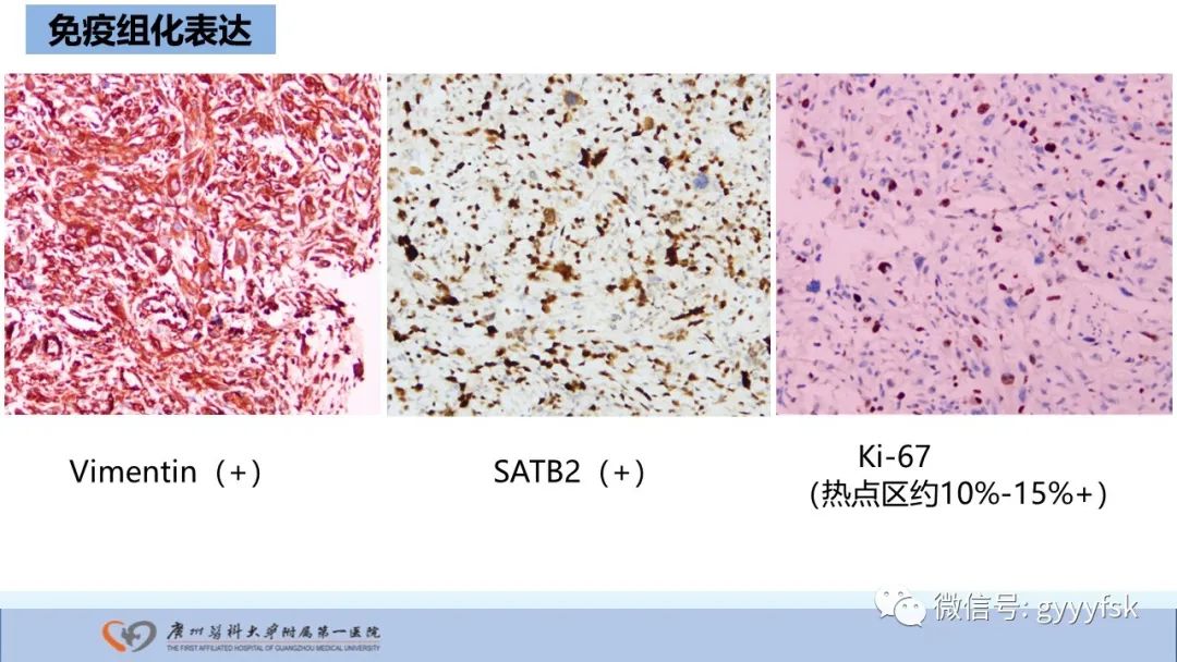 影像PPT - 【病例】股骨骨肉瘤1例X线CT及MR影像-39