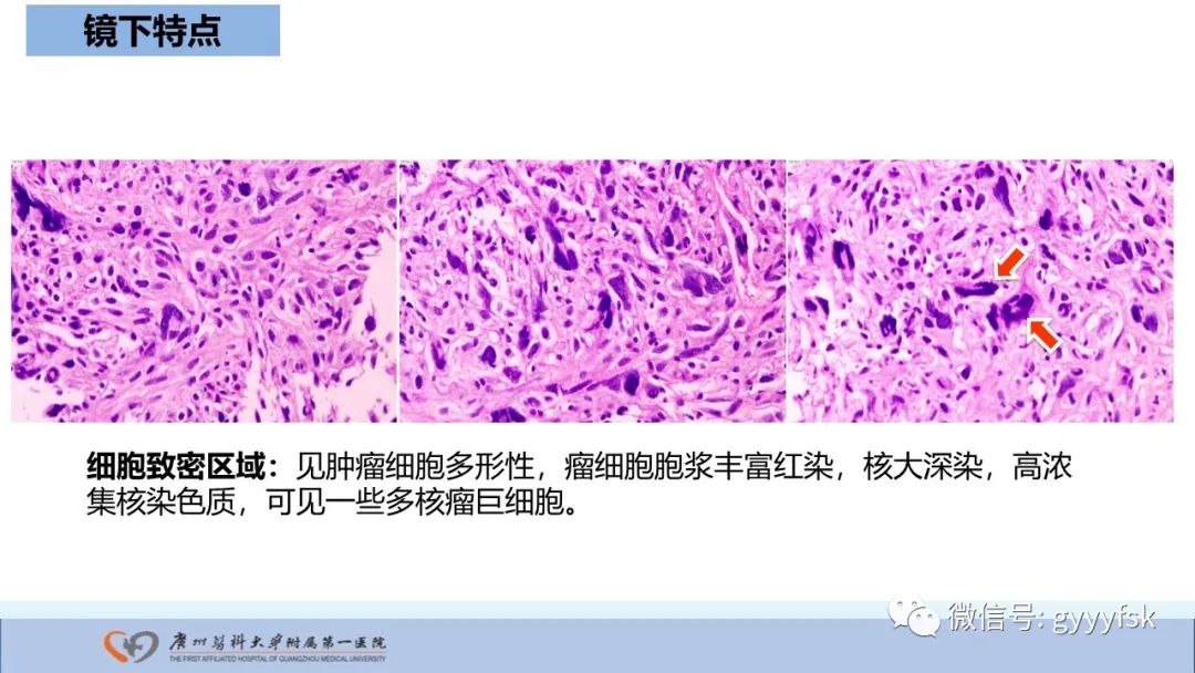 影像PPT - 【病例】股骨骨肉瘤1例X线CT及MR影像-36