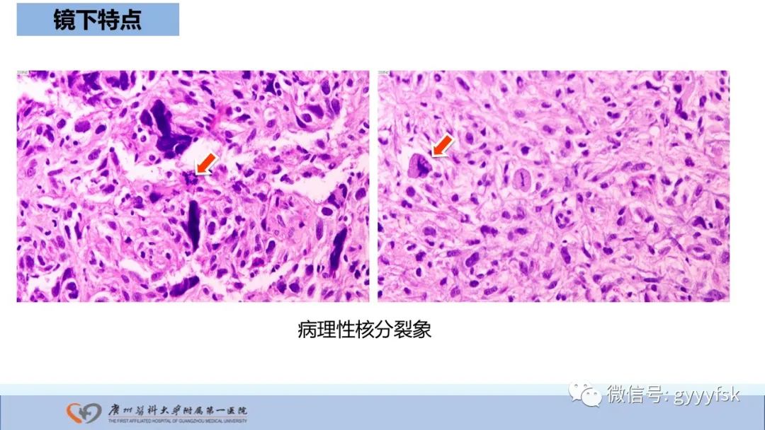 影像PPT - 【病例】股骨骨肉瘤1例X线CT及MR影像-37