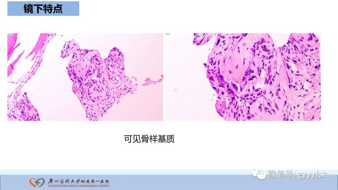 影像PPT - 【病例】股骨骨肉瘤1例X线CT及MR影像-38