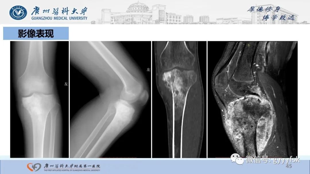 影像PPT - 【病例】股骨骨肉瘤1例X线CT及MR影像-45