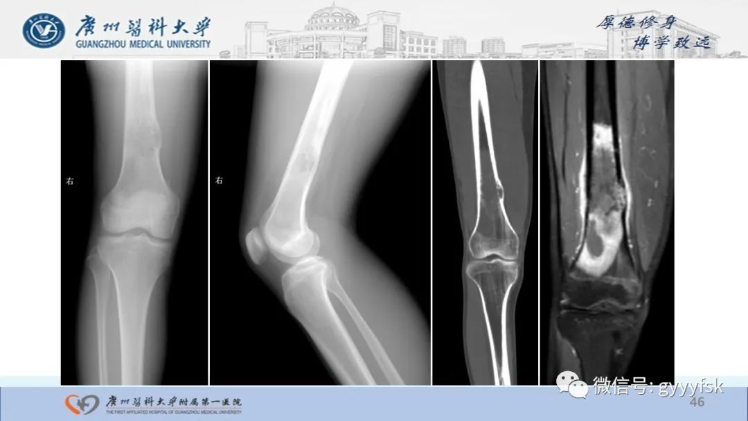 影像PPT - 【病例】股骨骨肉瘤1例X线CT及MR影像-46