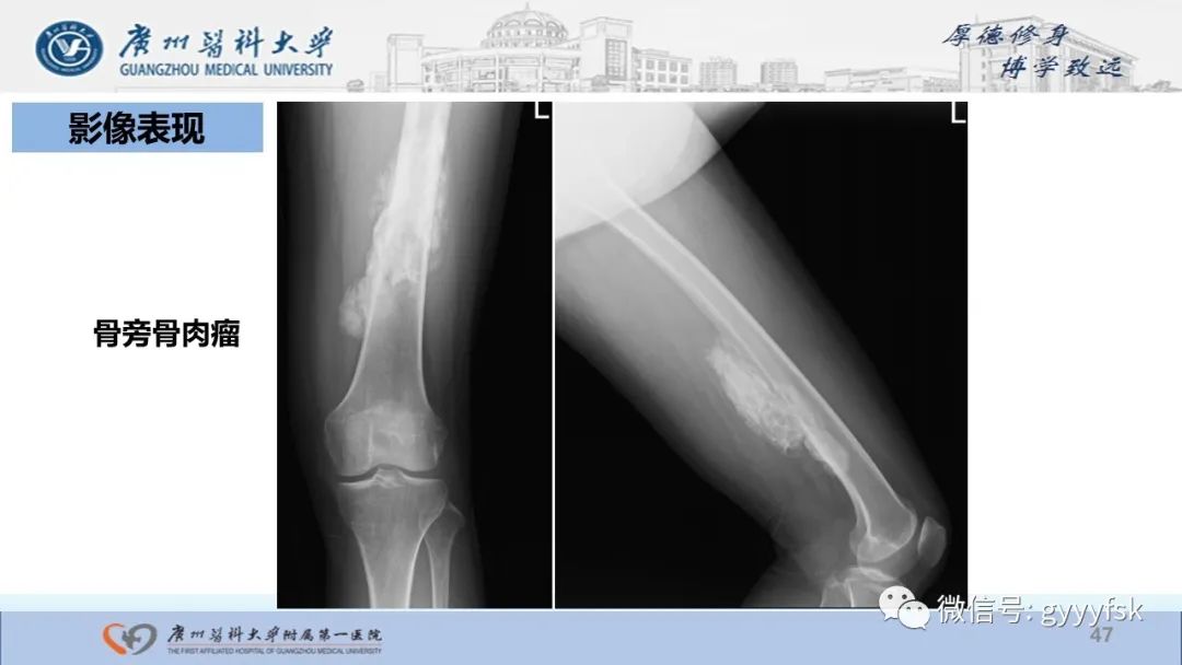 影像PPT - 【病例】股骨骨肉瘤1例X线CT及MR影像-47