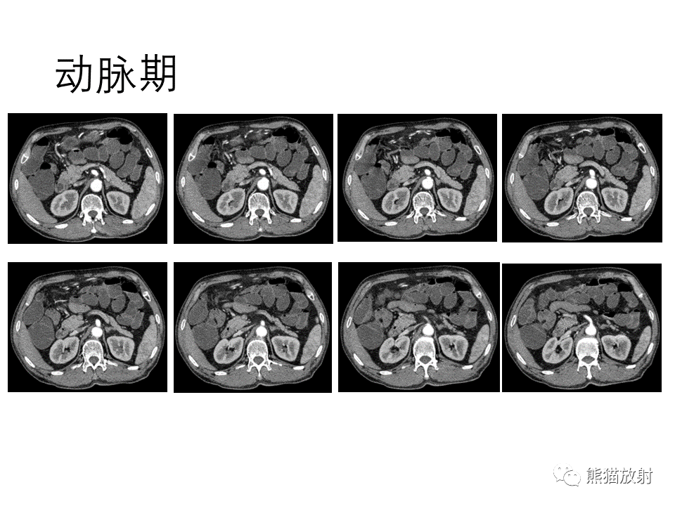 影像PPT - 【病例】正中弓状韧带综合征2例CT影像-4