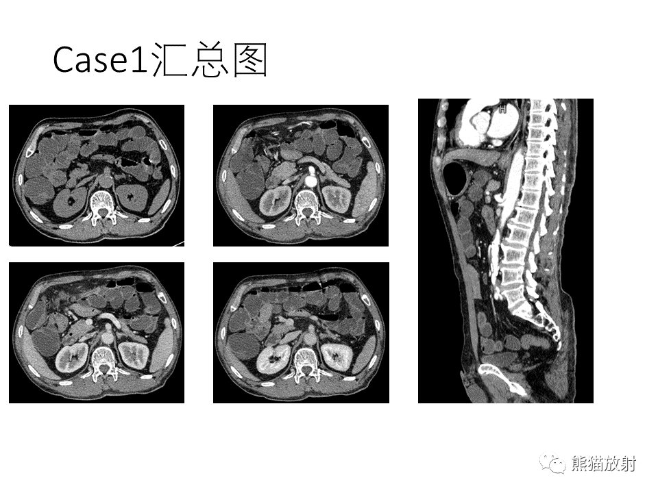 影像PPT - 【病例】正中弓状韧带综合征2例CT影像-3