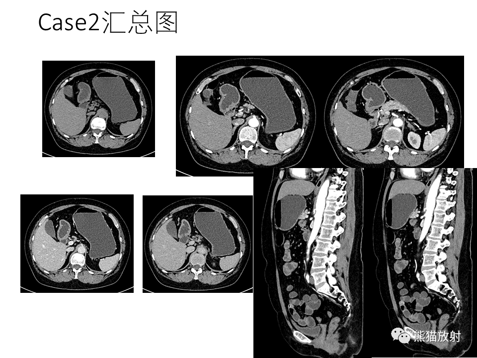 影像PPT - 【病例】正中弓状韧带综合征2例CT影像-8